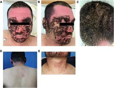 Cutaneous dirt-adherent disease complicated with Darier’s disease, schizophrenia, and cutis verticis gyrata: A case report